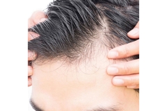 Image a close-up of a person's head losing hair